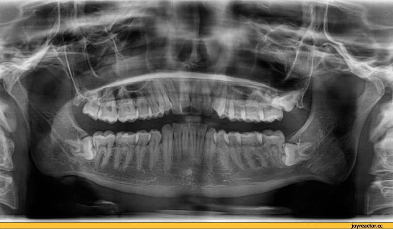 ,зубы,ортопанорама,мутация,песочница